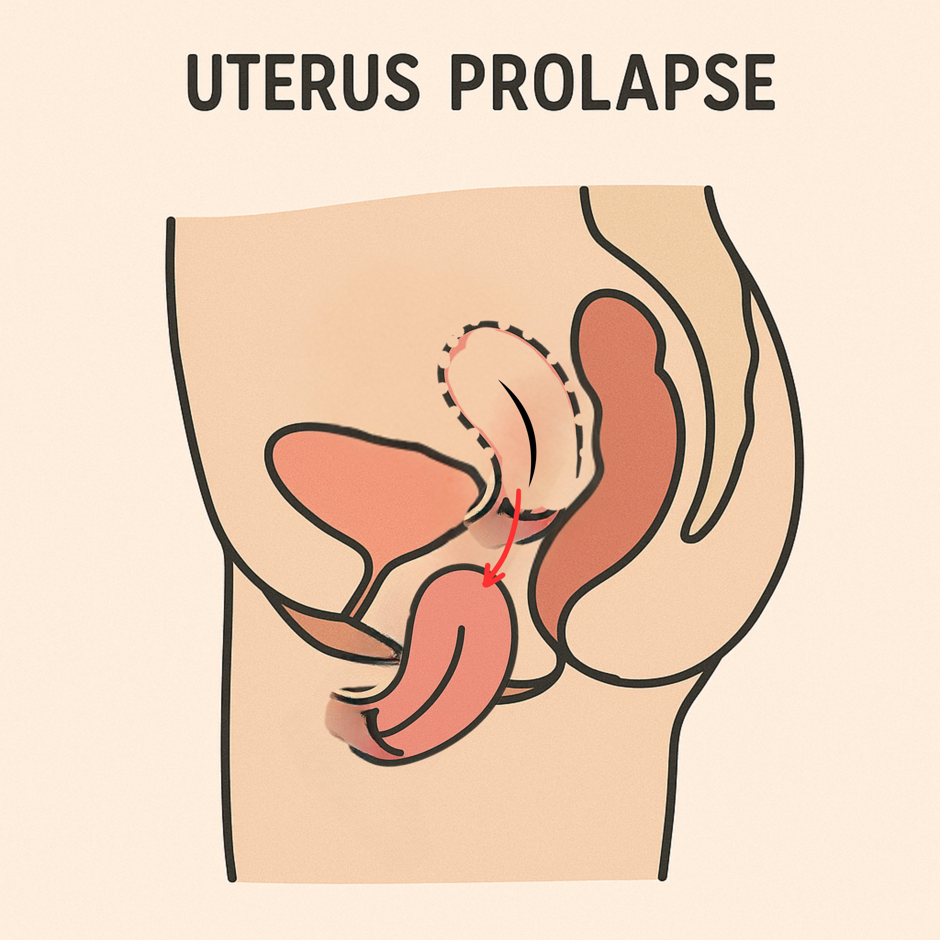 Uterine Prolapse